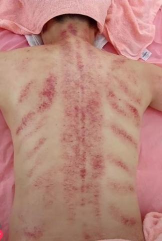 黃莉樺 - 美療師真心提醒給顧客的話:

當我們的身體受到疲勞和壓力的影響時，經絡按摩可以

幫助我們恢復能量和活力。肩膀僵硬、頭痛、失眠 

不適症狀.都可以透過經絡按摩可以得到緩解.讓身體

得到充分的休息和修復. 當身體充滿活力與能量皮膚跟

體態才能展現更好的狀態，讓我們外表美麗和內在健康

做出完美地結合。{顧客享受油壓後刮痧作品}

