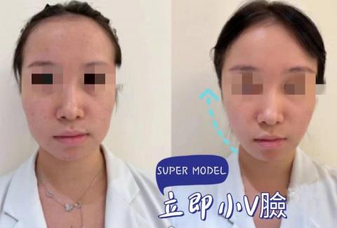 舒芯時尚護膚美學 - 消水腫瘦小臉