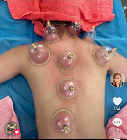 黃莉樺 - 美療師真心提醒給顧客的話:

當我們的身體受到疲勞和壓力的影響時，經絡按摩可以

幫助我們恢復能量和活力。肩膀僵硬、頭痛、失眠 

不適症狀.都可以透過經絡按摩可以得到緩解.讓身體

得到充分的休息和修復. 當身體充滿活力與能量皮膚跟

體態才能展現更好的狀態，讓我們外表美麗和內在健康

做出完美地結合*   {顧客享受油壓後拔罐作品}
