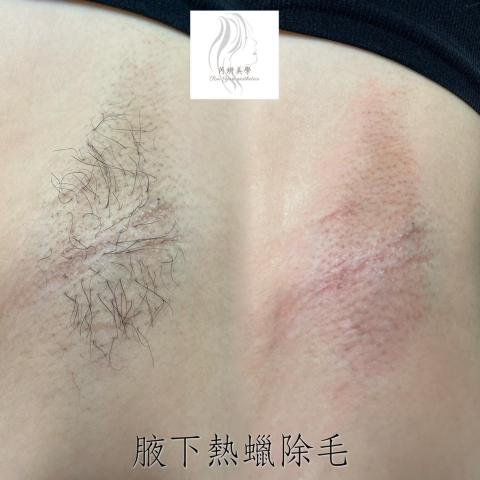 芮妍美學 - 腋下熱蠟除毛