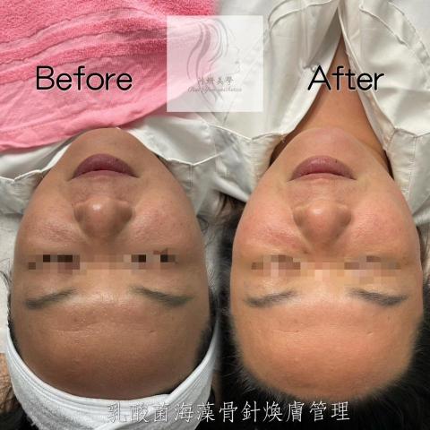 芮妍美學 - 乳酸菌海藻骨針喚膚管理