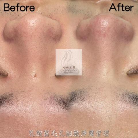 芮妍美學 - 毛孔大掃除