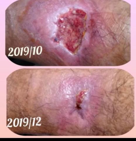 小賴護理師 - 車禍後小腿傷口難以癒合，經過文雅護理師調理兩個月，省下傷口清創的醫療費用，並且縮短傷口治療時間。