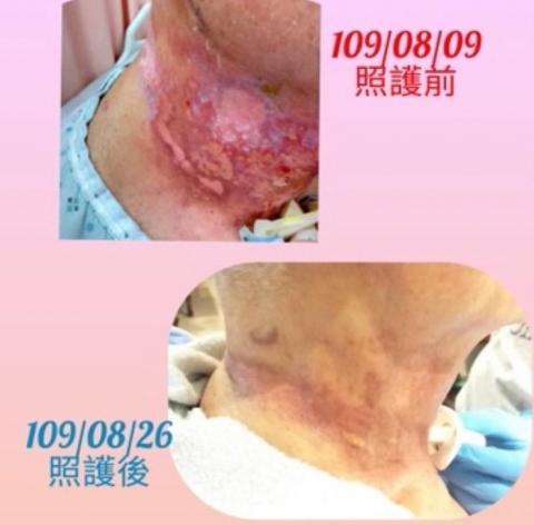 小賴護理師 - 放射線治療後的皮膚狀況非常不穩定，難以照顧，居家傷口照護短短14天傷口癒合良好。