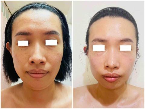 新莊-蓁SPA撥經美顏館 - 臉部:花晶小顏V