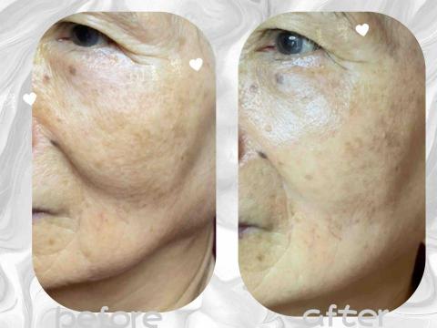 IN美學 - 撥筋可以立即看到小V臉，無痛感，無副作用