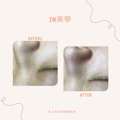 IN美學 - 滿滿的黑頭粉刺，手工清理，儀器選用也很重要喔