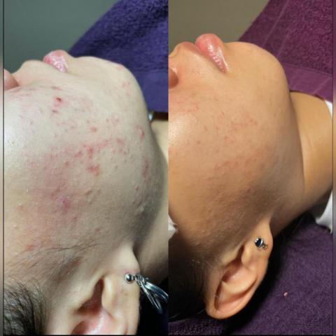 李大慈 - 治療痘痘肌膚專家