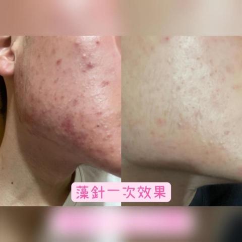 李大慈 - 治療痘痘肌膚