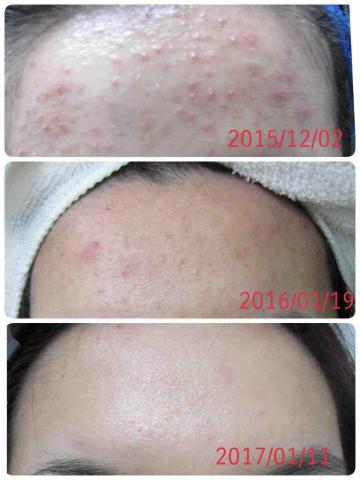 苡起變亮 - 痘痘改善