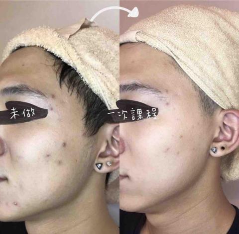 苡起變亮 - 痘疤淡化 拉提緊緻 提亮膚色