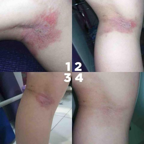 小太陽健康屋Fit nutrition -  異位性皮膚炎，透過均衡飲食方式改善，目前已無復發，不需再吃藥抹藥膏