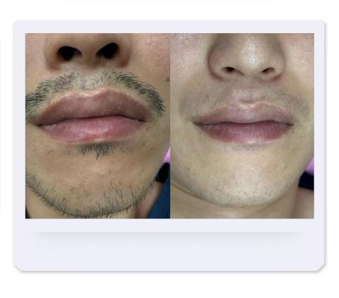 歆星工作室 - 臉部全除