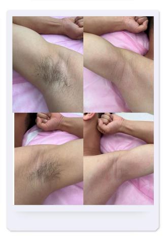 歆星工作室 - 腋下除毛