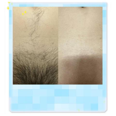 歆星工作室 - 男仕私密處全除