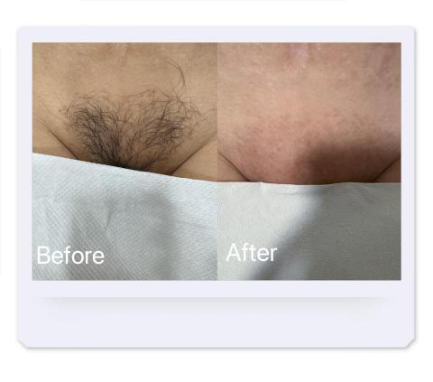 歆星工作室 - 私密處全除