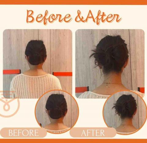 Vivian - 駝背矯正前後對比圖