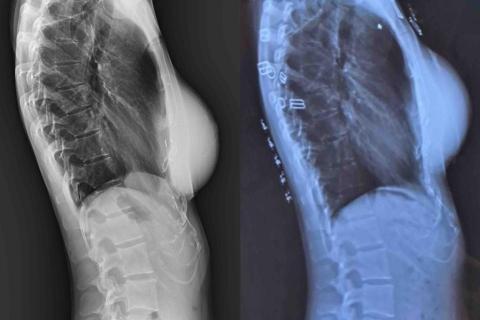 Vivian - 駝背矯正前後對比圖