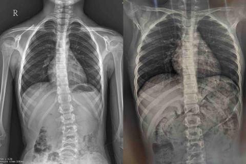 Vivian - 側彎矯正前後對比圖