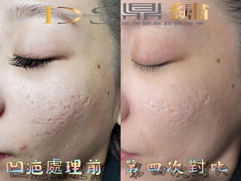 Ds鼎繡國際極緻紋飾美學~桃園民權總店 | 北投石牌店   - 皮膚特殊處理(凹疤處理) Ds鼎繡國際極緻紋飾美學~桃園民權總店 | 北投石牌店   - 皮膚特殊處理(凹疤處理)