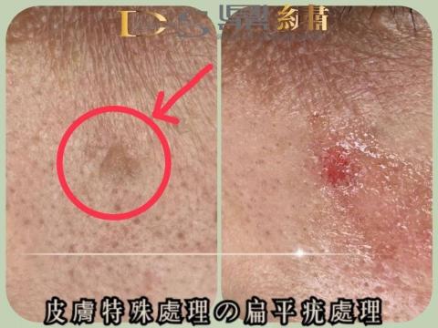 Ds鼎繡國際極緻紋飾美學~桃園民權總店 | 北投石牌店   - 皮膚特殊處理(扁平疣) Ds鼎繡國際極緻紋飾美學~桃園民權總店 | 北投石牌店   - 皮膚特殊處理(扁平疣)