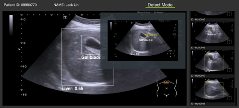 Harry Huang - Abdominal Ultrasound AI