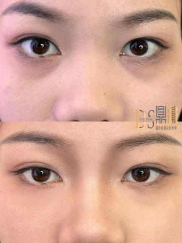 Ds鼎繡國際極緻紋飾美學~桃園民權總店 | 北投石牌店   - 鼻部綜合(扇形眼窩,鼻側影) Ds鼎繡國際極緻紋飾美學~桃園民權總店 | 北投石牌店   - 鼻部綜合(扇形眼窩,鼻側影)