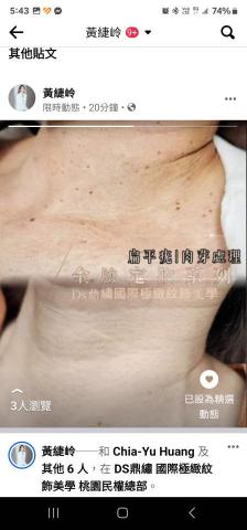 Ds鼎繡國際極緻紋飾美學~桃園民權總店 | 北投石牌店   - 皮膚特殊處理(扁平疣,肉芽處理) Ds鼎繡國際極緻紋飾美學~桃園民權總店 | 北投石牌店   - 皮膚特殊處理(扁平疣,肉芽處理)