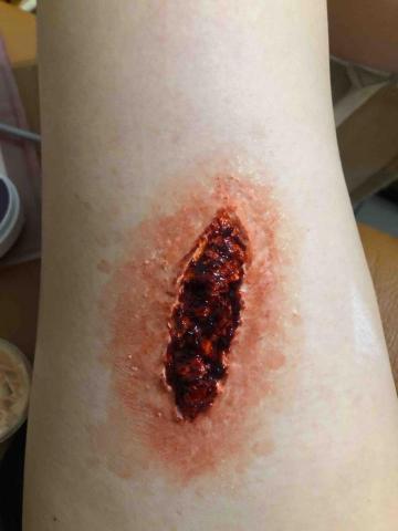 張梓涵 - 撕裂傷