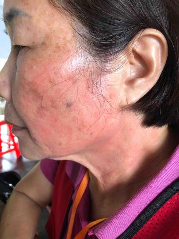 張梓涵 - 輕度灼傷