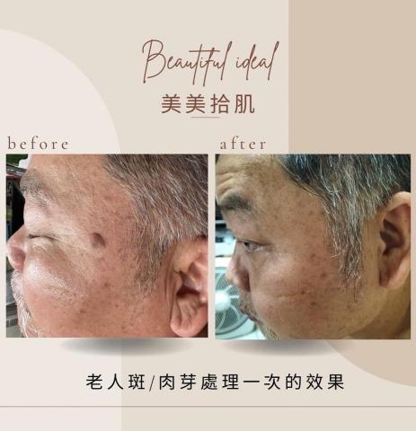 美美拾肌-問題肌膚美學 - 你臉上也有凸凸老人斑嗎？
而且會越長越大
有時候會癢 有時候摳到不舒服
凸凸的覺得不美觀 洗臉不平滑

來找美美拾肌 
還你一張美美的肌膚

▫️獨特手工技術
▫️不用雷射
▫️不用電燒
▫️不留疤
▫️不疼痛
▫️恢復快、好照顧

困擾的肉芽、老人斑問題，
不用擔心相信我、交給我
一定能夠給你乾淨平滑的肌膚

#肉芽 #脂肪球 #皮脂腺增生 
#黑痣 #肉痣 #老人斑 #曬斑 #雀斑
#水光肌 