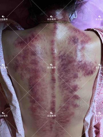 貝貝/舒壓你的背 - 中暑刮痧