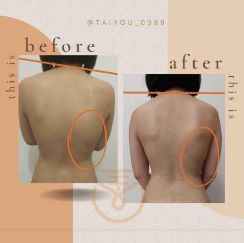 態優健護賦能中心桃園中山店 - 駝背，高低肩，右背突起