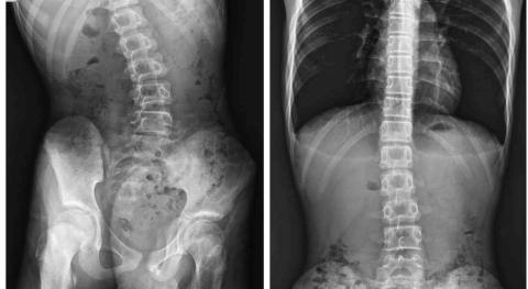 態優健護賦能中心桃園中山店 - 客戶脊椎側彎回傳前後圖