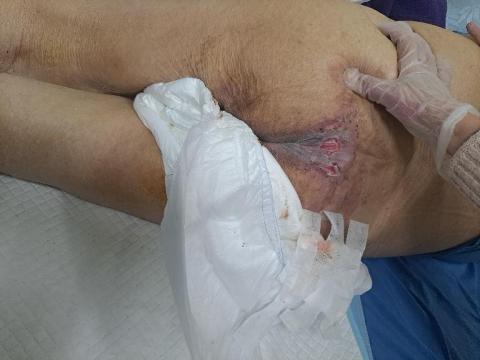 劉珏伶 - 協助傷口照護