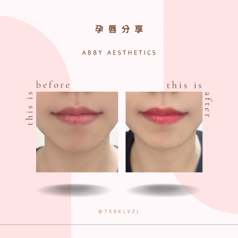 Abby美學工作室 - ?孕唇術是一種非侵入性的MTS操作方法
利用奈米晶片高頻振動+天然植物性色料，導入到表皮層下。
自然、水嫩、豐潤清透感、裸妝效果
淡化唇部暗沈、代謝老廢角質、
解決唇色不均勻問題、減少黑色素沈澱

?孕唇適用對象：
唇部暗沈、唇部乾燥、追求自然、怕痛者