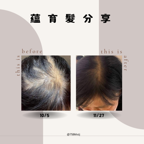 Abby美學工作室 - ?育髮是利用產品及儀器導入，將精華液滲透頭皮
提供毛囊營養，增強頭髮強韌，促進頭髮生長
非紋髮非侵入，建議搭配居家保養，效果會更好唷

?科技育髮
?外泌體+營養安瓶
?適合以下族群：
雄性禿/產後掉髮/壓力掉髮/分線明顯/髮旋稀疏