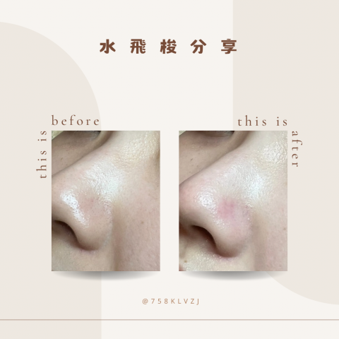 Abby美學工作室 - ?水飛梭是利用真空負壓旋渦作用，清除臉上髒污、粉刺、代謝老廢角質、通暢毛孔，溫和不傷皮膚，清潔的同時也在注入營養液提供肌膚保濕補水，達到肌膚透亮、水嫩亮白、油脂平衡。