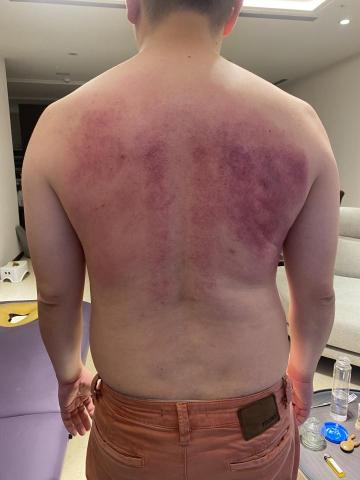 Ray - 幫客戶施行火罐調理，使陳年體內寒濕浮於體表，身體一些不舒服症狀消失緩解