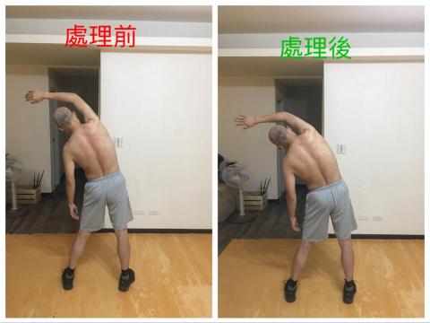 Ray - 幫客戶調理筋膜問題前後對照，原本側彎疼痛消失，活動範圍增大
