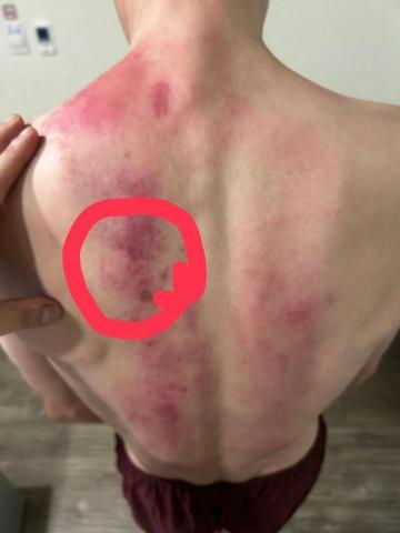 林師傅專業到府按摩整復服務 - 心血管有阻塞疼痛，排出體外，非刮痧手法。