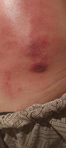 林師傅專業到府按摩整復服務 - 腰痛點排出。