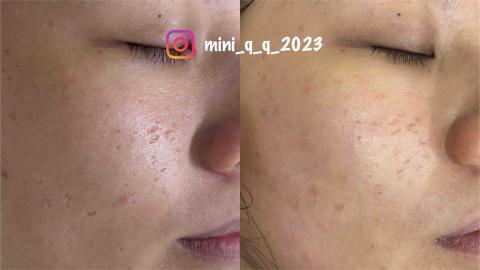 Yun-Ching Sun -  臉部痘坑修復一次對比