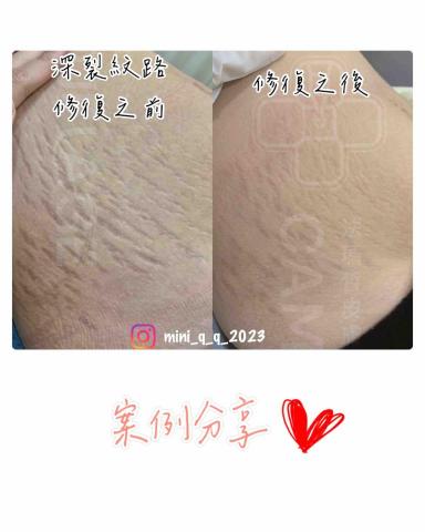 Yun-Ching Sun - 凹陷紋路修復三次對比