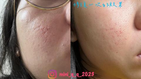 Yun-Ching Sun - 法式永膚修復一次的效果