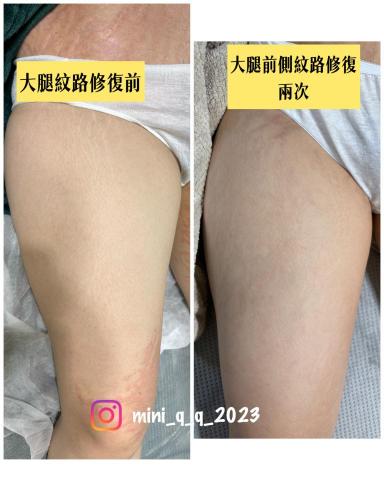 Yun-Ching Sun - 法式永膚修復兩次的效果