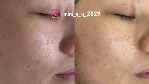 Yun-Ching Sun - 法式永膚修復痘坑一次的效果