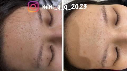 Yun-Ching Sun - 法式永膚修復痘坑一次的效果
