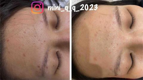 Yun-Ching Sun - 臉部痘坑修復一次對比