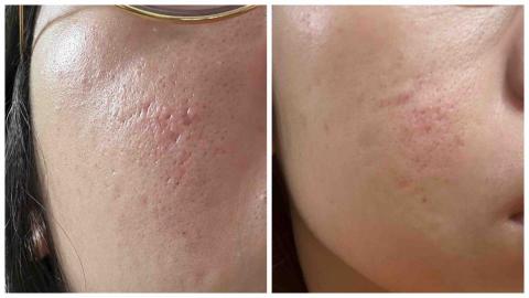 Yun-Ching Sun - 臉部痘坑修復一次對比